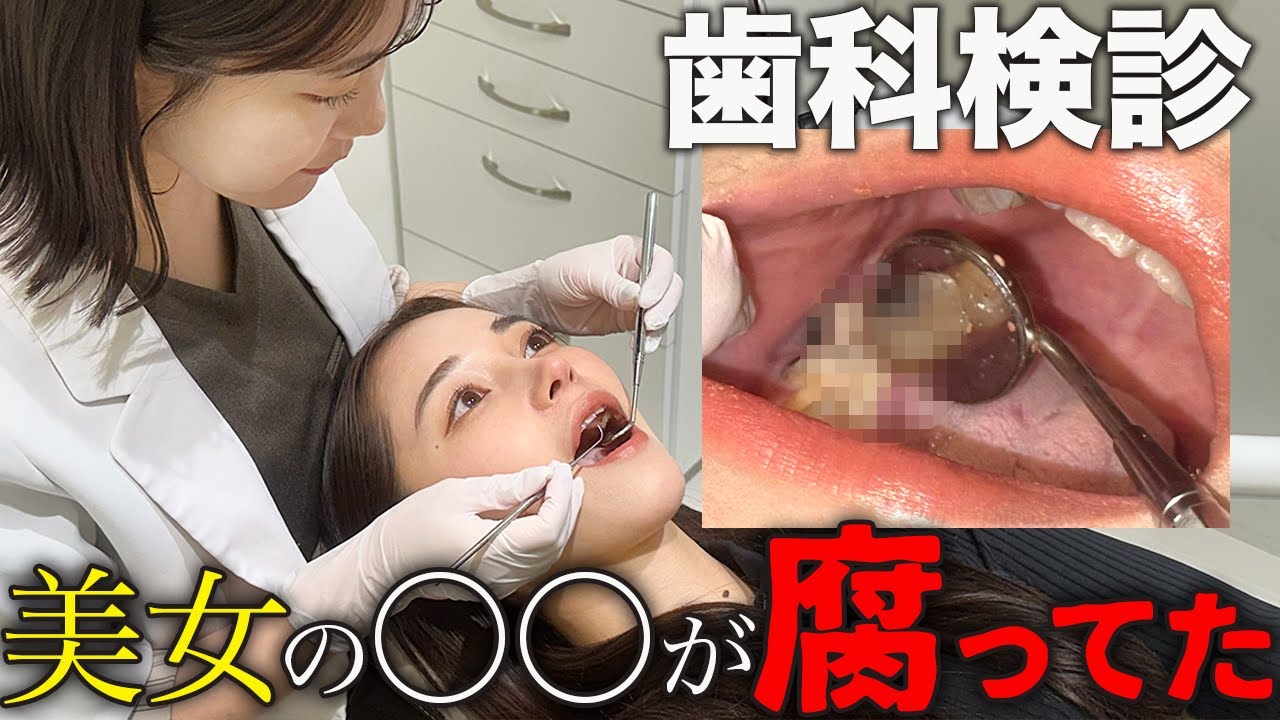 【密着】虫歯が7本も？！美女の歯科治療！