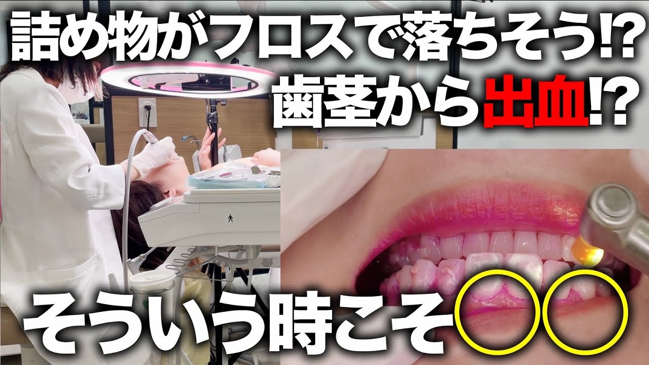 3日間分の歯の汚れをクリーニングしながら解説してみた！