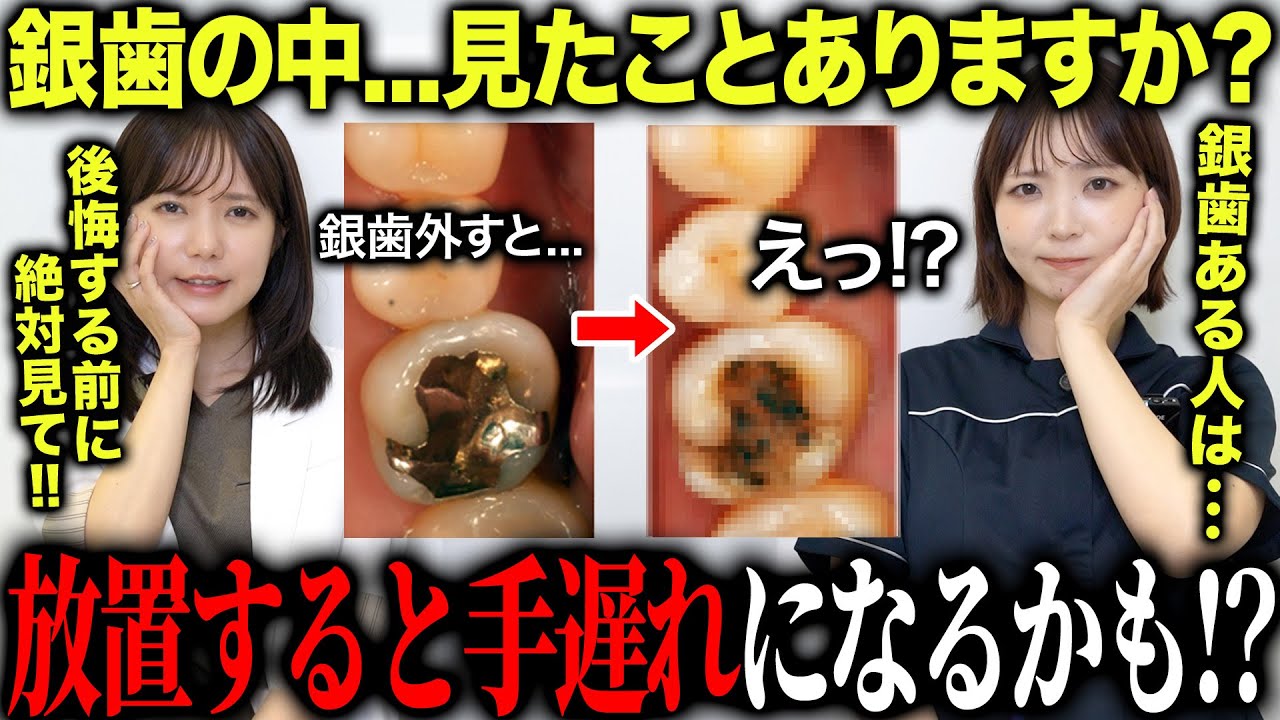 銀歯ある人へ...中では「見えない虫歯」が進んでいます。