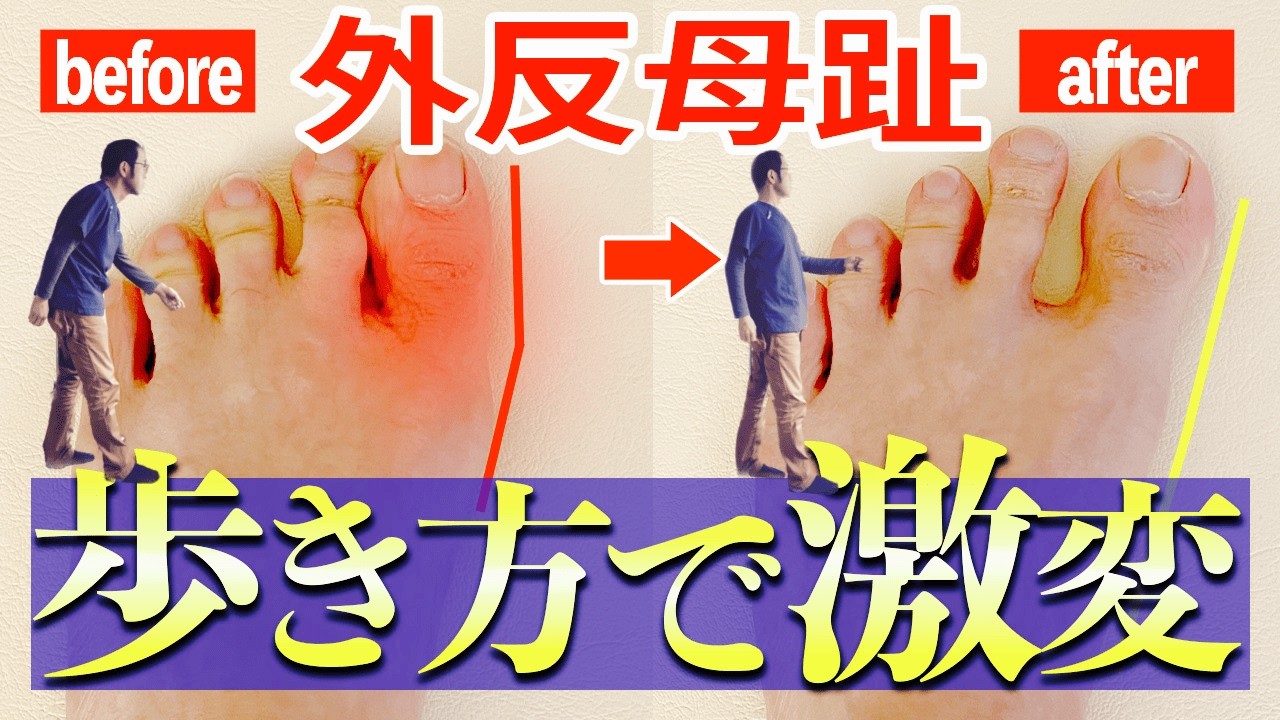 【手術はやめて！】外反母趾は歩き方で改善します