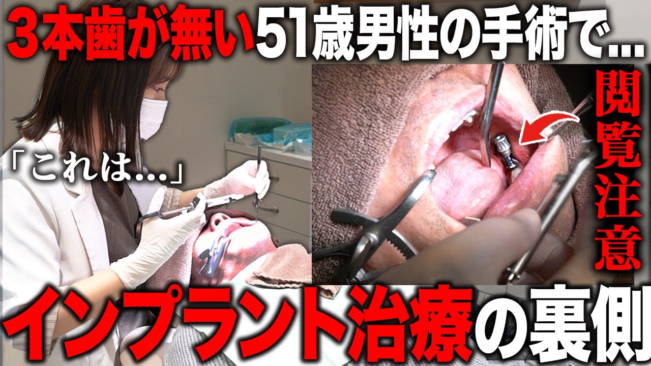 【歯科恐怖症は必見】6回の治療が1回で終わる！？寝るだけの痛くないインプラント手術を全てお見せします【静脈内鎮静法】