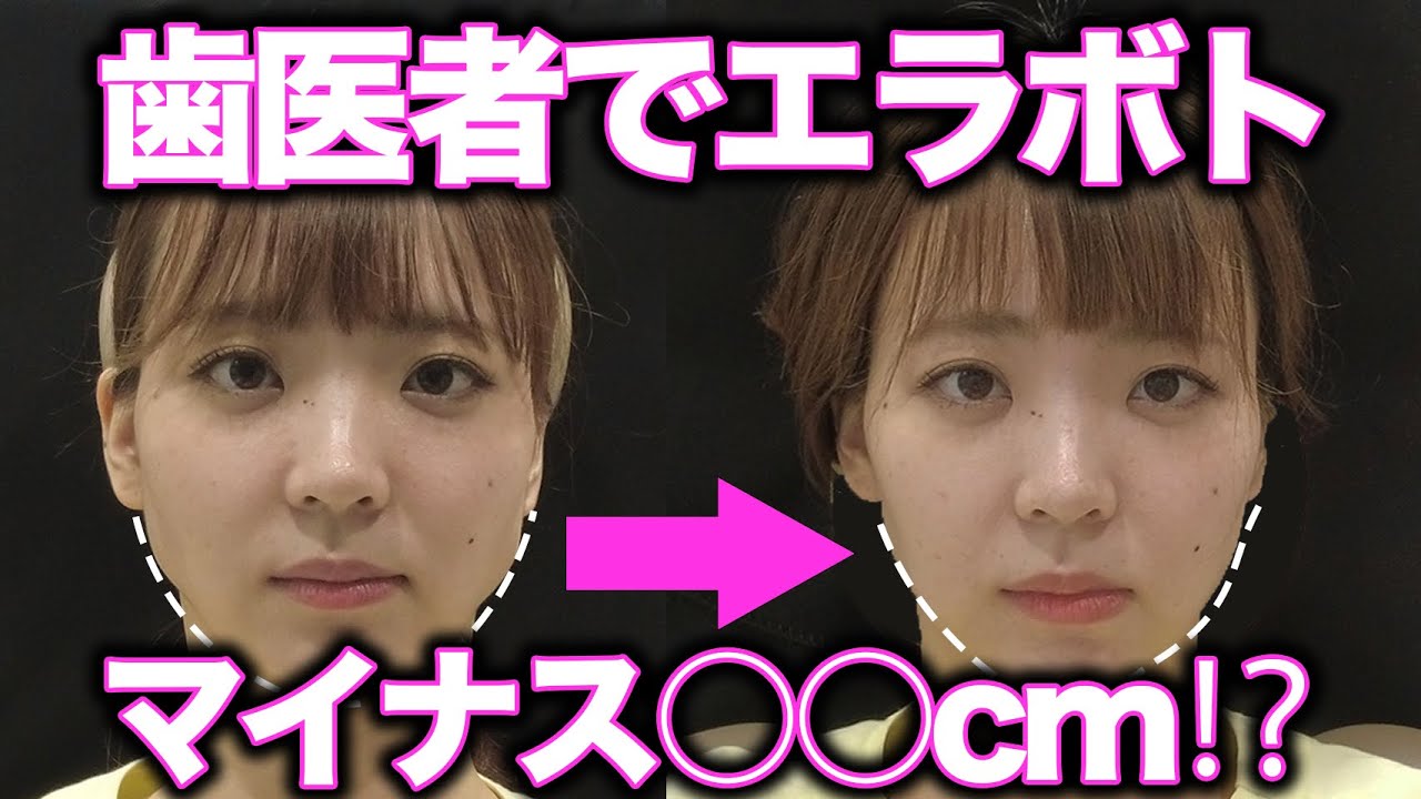 【エラボトックス】歯医者で打って驚きの結果に?!【小顔/歯ぎしり】