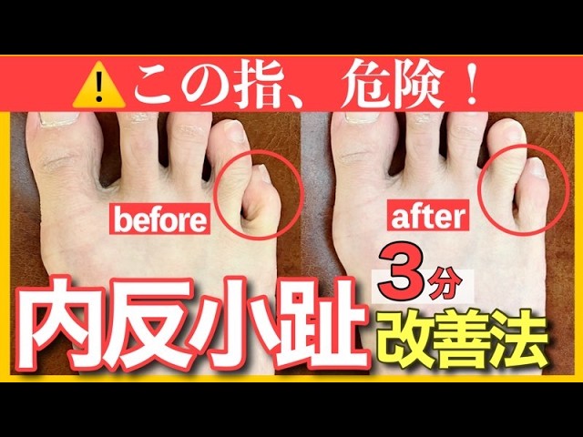 【内反小趾】放置厳禁！寝指の3分簡単調整法