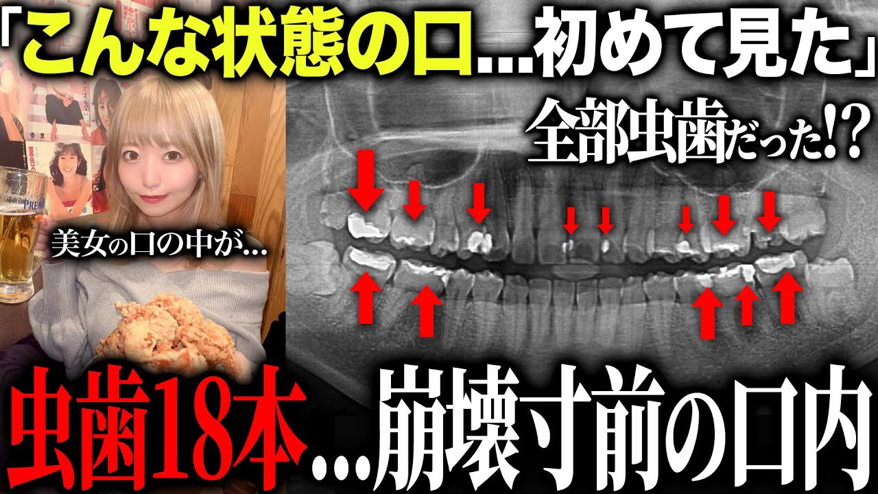 【衝撃】虫歯18本！？治療が怖くて途中で歯医者に通うのを辞めたグラドルの口の中が過去1やばかった