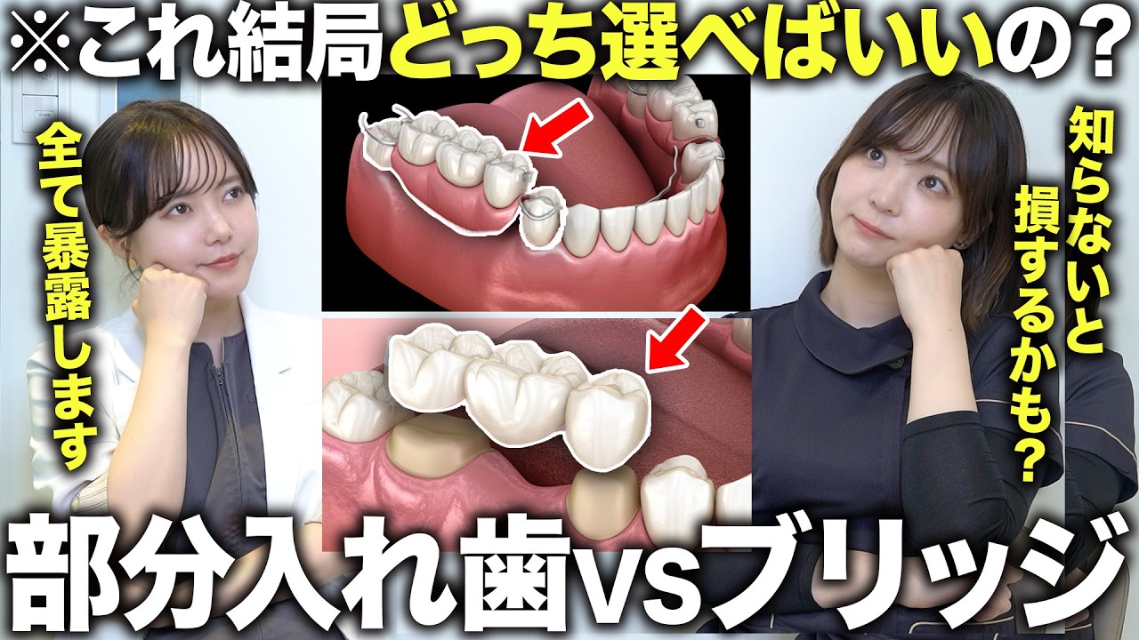 5年後に差が出るのはどっち？ブリッジ vs 入れ歯【歯医者が解説】