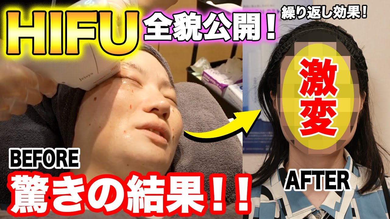 最新HIFU(ハイフ)を受けた結果がスゴすぎた！