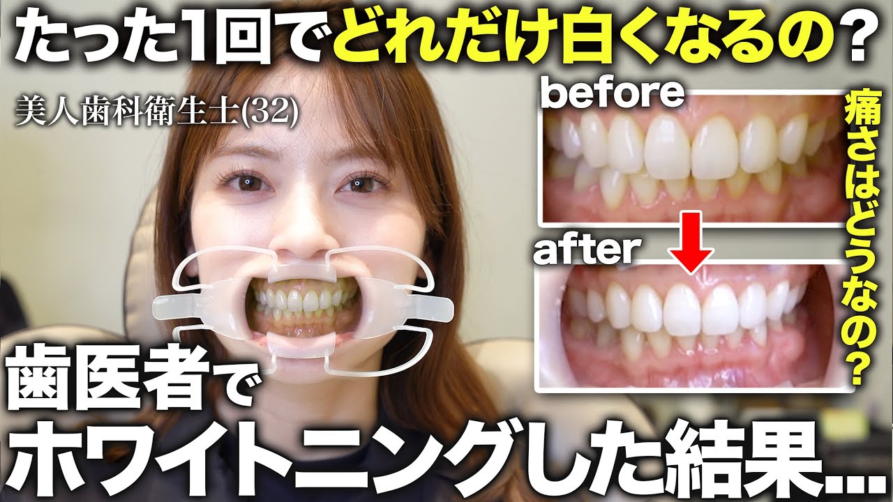 【ホワイトニング】現役歯科衛生士にいきなり医療ホワイトニングしたらたった1回でかなり黄ばみが落ちて「モテる歯」なった！