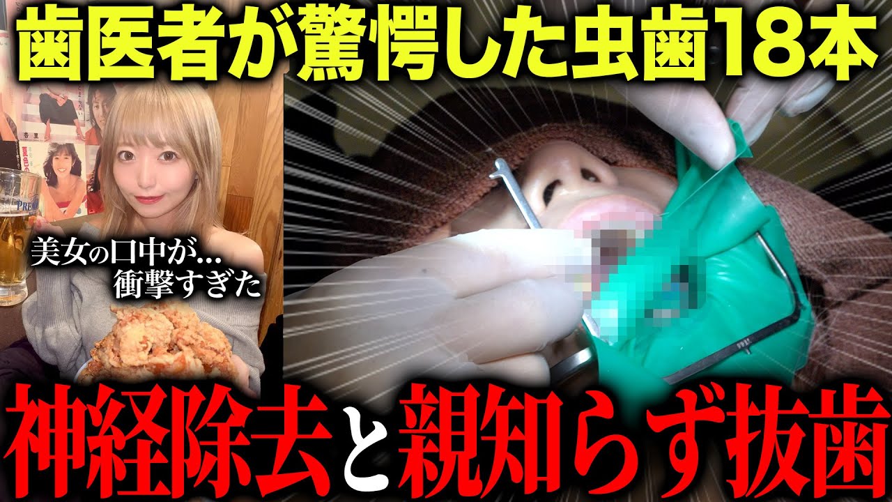 【歯科恐怖症】美女の口に潜む18本虫歯…神経除去＆親知らず抜歯の治療がついに開始