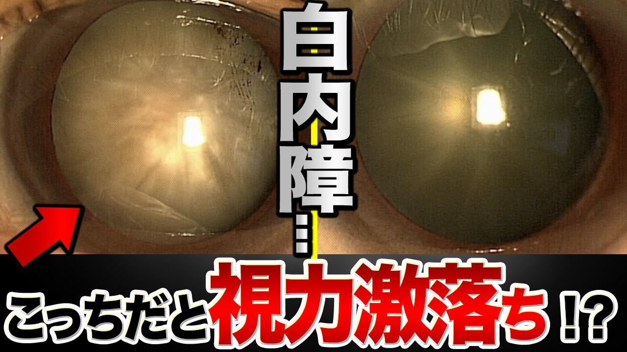 【閲覧注意】白内障！緊急手術が視力を守る！？急ぐ理由を眼科医が解説！