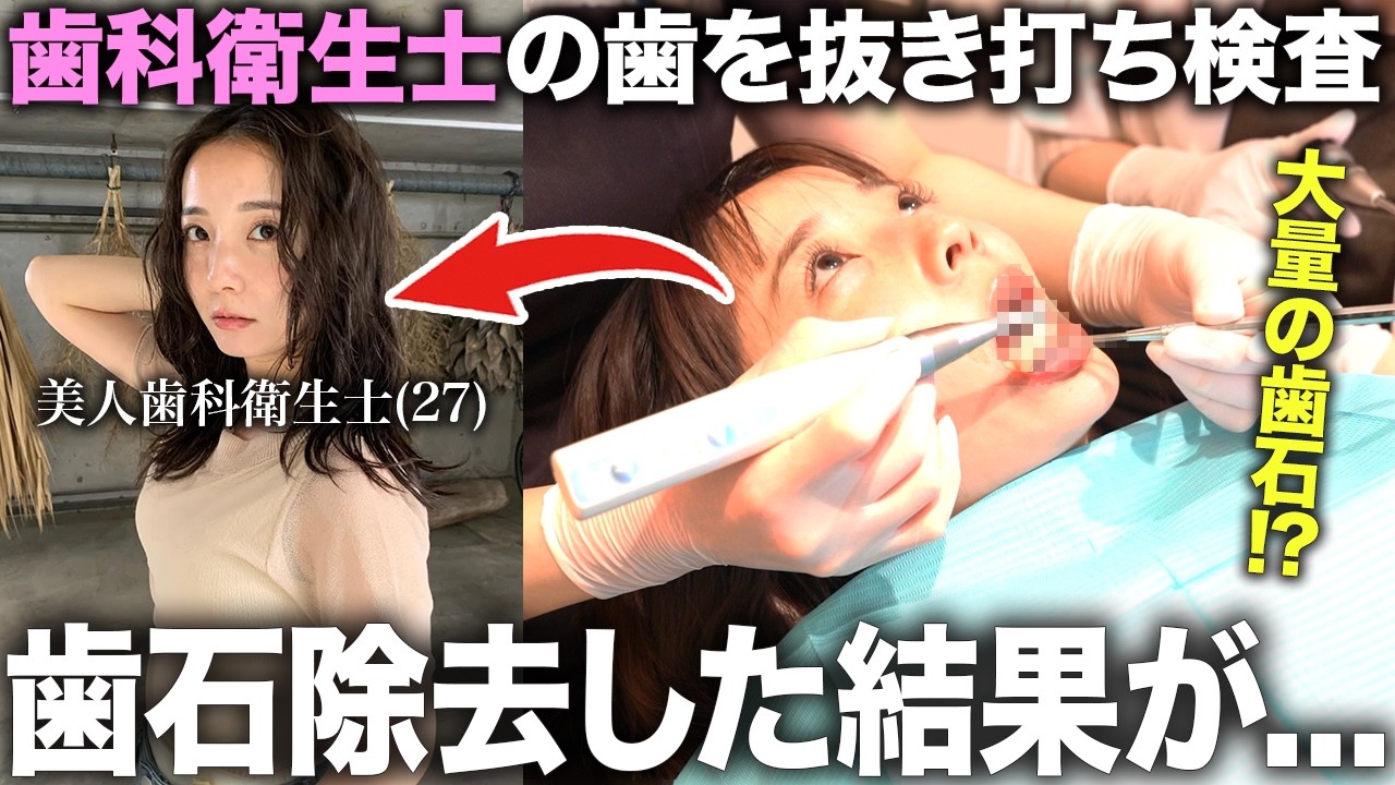 【歯石除去】現役の美人歯科衛生士の歯周ポケットに隠れた歯石を取ったら大量の歯石が...!?