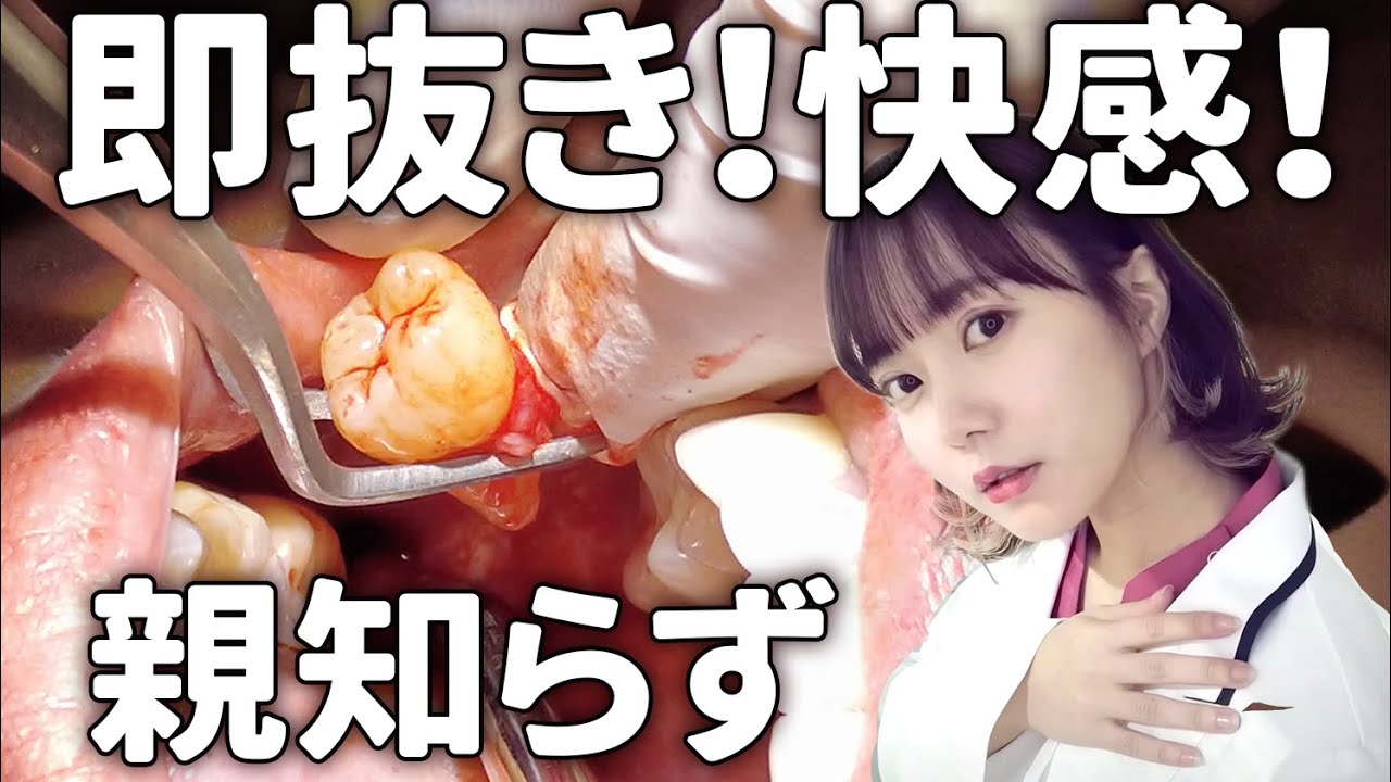 【閲覧注意】親知らずの抜歯、全部お見せします！抜歯中、抜歯後のポイントも！