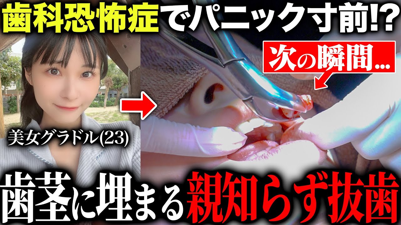 【歯科恐怖症】あまりの痛みに「もう無理かも...」と逃げた美女グラドルの完全に埋まった「親知らず抜歯手術」を全て公開します