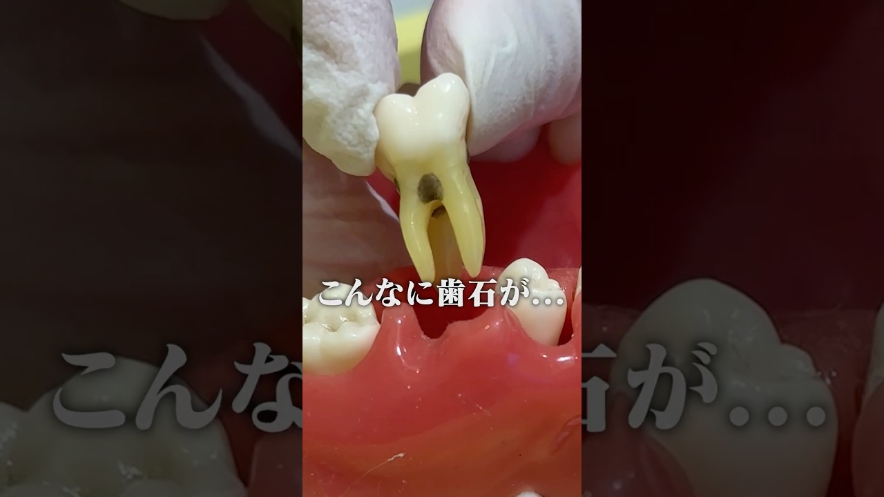 歯茎が腫れやすい人は危険です！