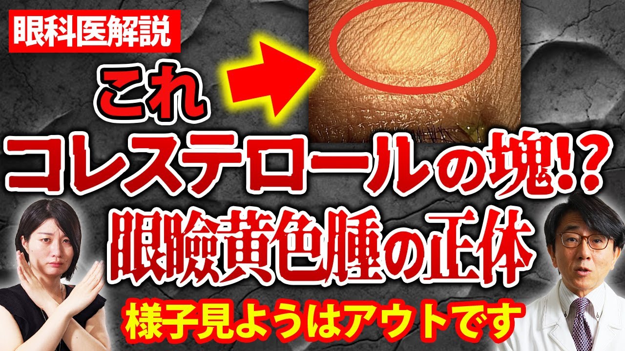 まぶたがぷっくり浮き出る！？それ眼瞼黄色腫です。【眼科医解説】