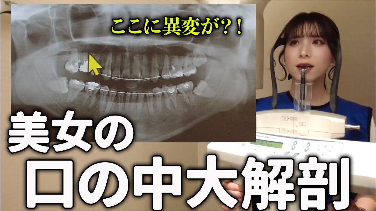 【レントゲン】美女の口腔内を丸裸！【矯正】