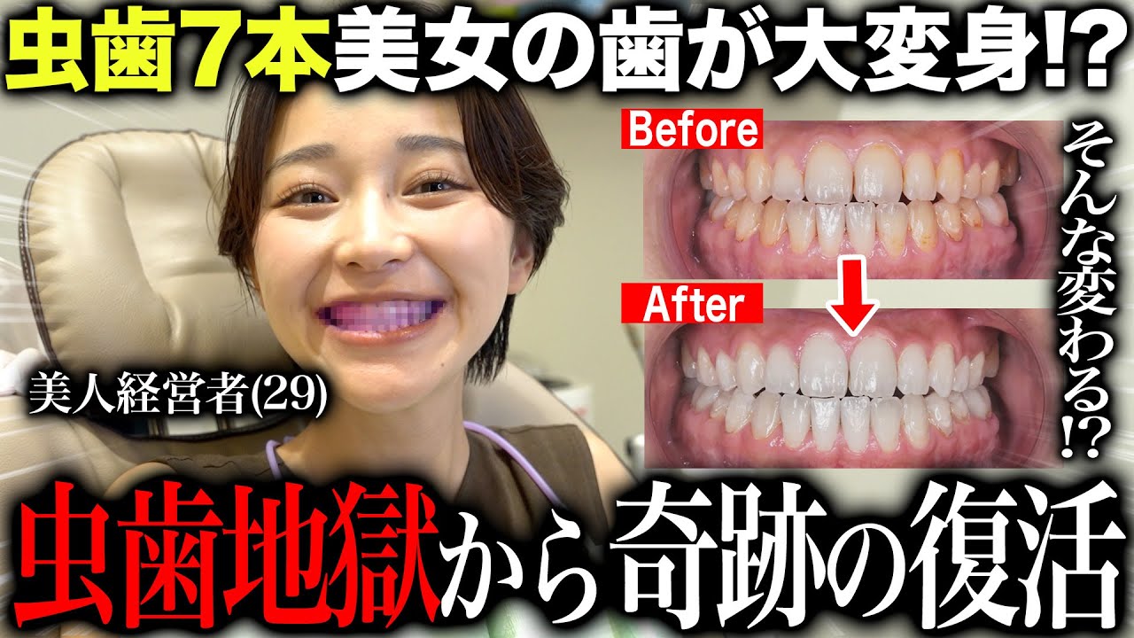 歯が腐り抜歯手術をした虫歯が７本ある美女経営者の歯の歯石チェック&ホワイトニングで大変身！？