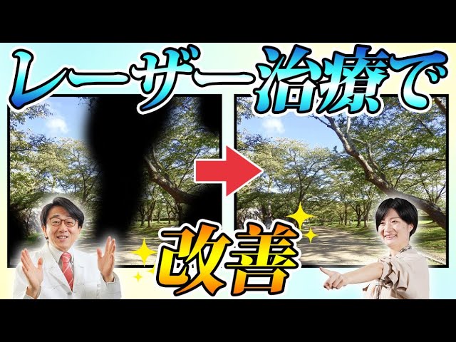 ぼやける、かすむなど中心静脈分枝閉塞症の症状をレーザーで改善します！