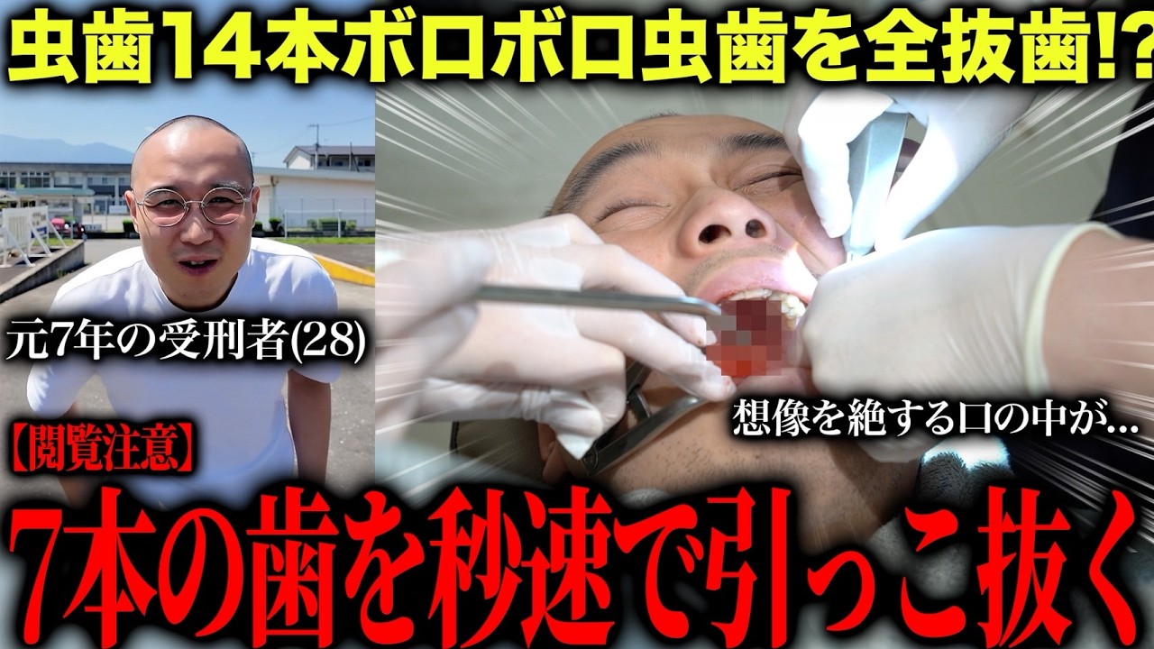 【元受刑者の虫歯治療】1日で抜歯7本   !  懲役7年でボロボロで14本の虫歯の治療を開始したら口の中が絶望的な状況でした