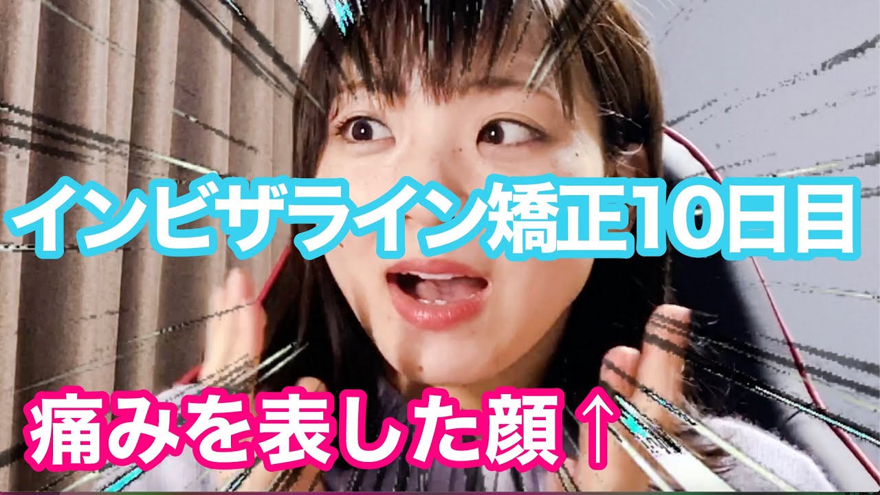 ⑤インビザライン矯正１０日目の感想は痛い！？着色も•••！？