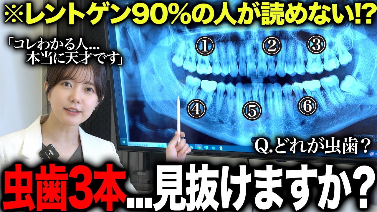 【一般の方の9割は見抜けない!?】このレントゲンに隠れた虫歯3本、あなたはわかりますか？