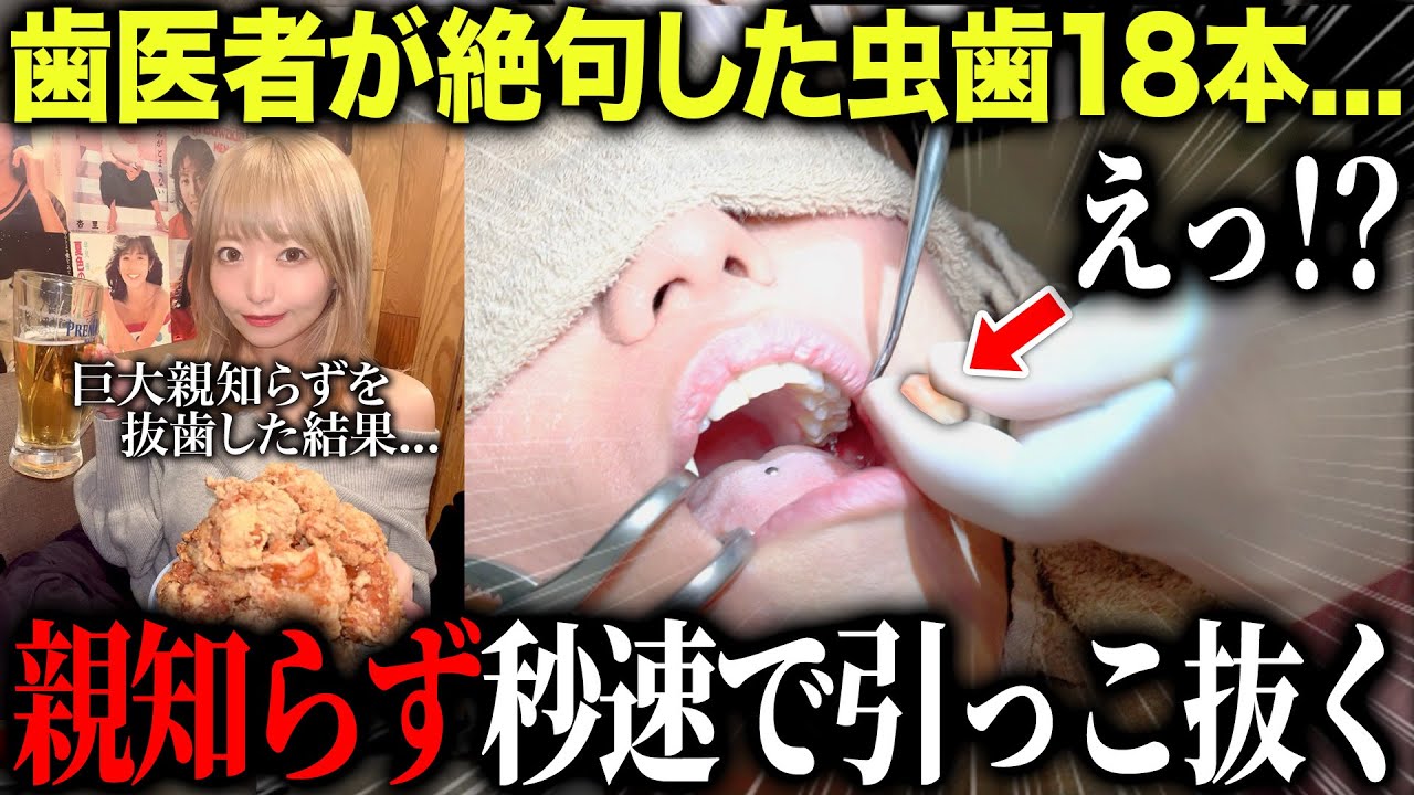 【歯科恐怖症】虫歯18本の美女の“巨大親知らず”を抜歯したら…まさかの展開に