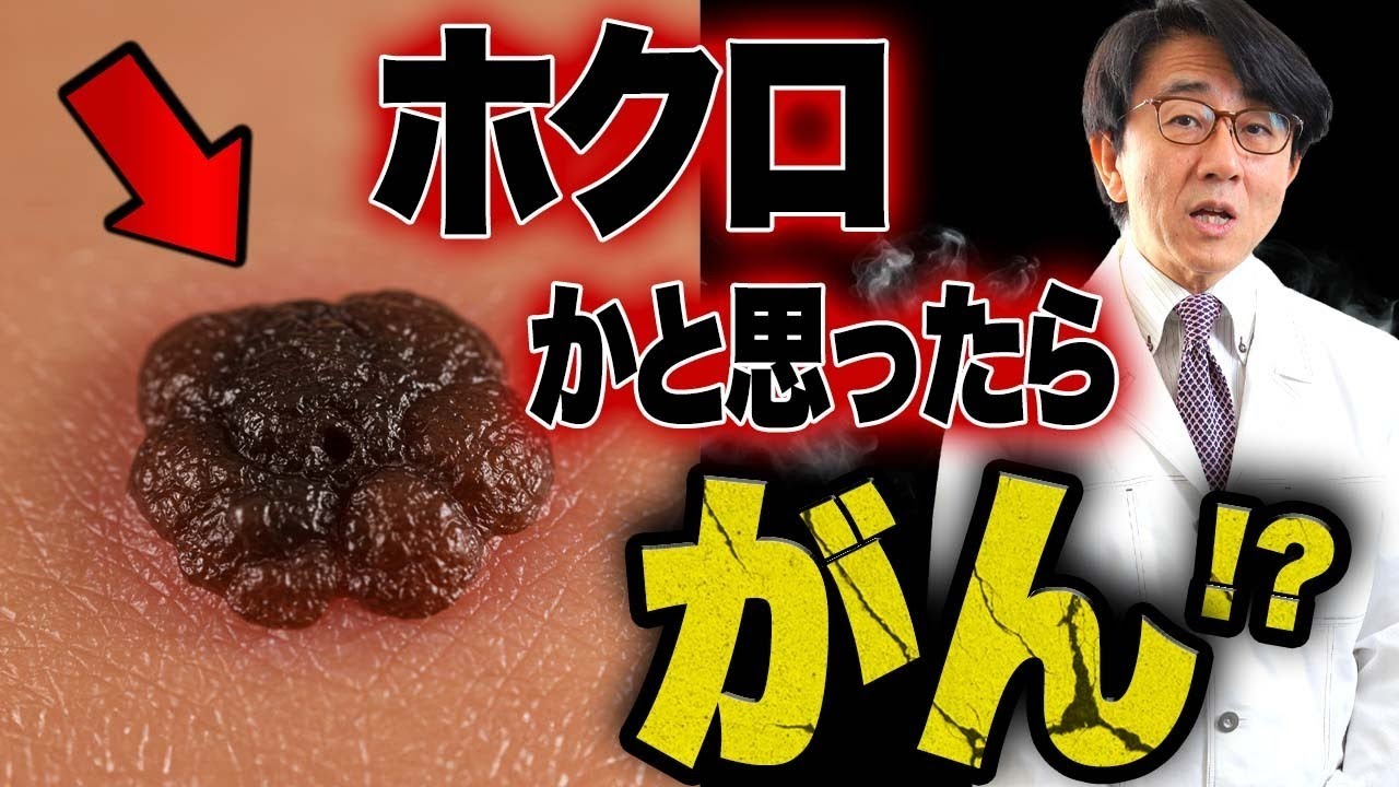 手遅れになる前にすぐ病院に！こんなホクロに気をつけて！！
