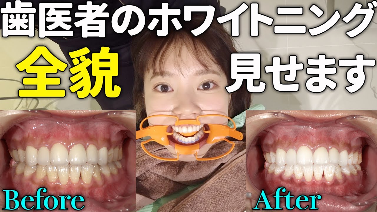【ホワイトニング】１回で７トーンも白くなりました！流れも全部見せちゃいます！