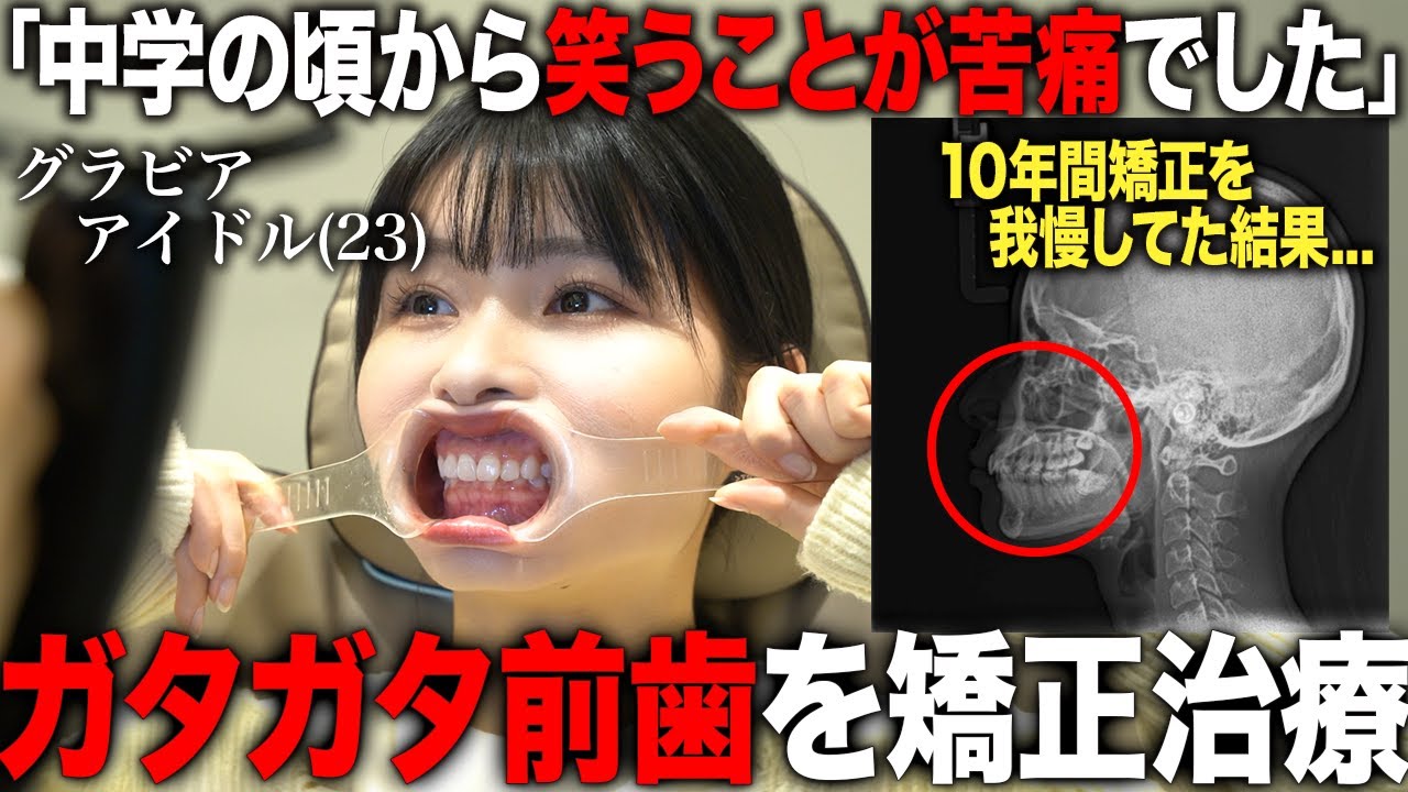 【歯列矯正】歯のせいで笑えなくなったガタガタの歯に悩む美女グラドルのマウスピース型矯正治療に密着！