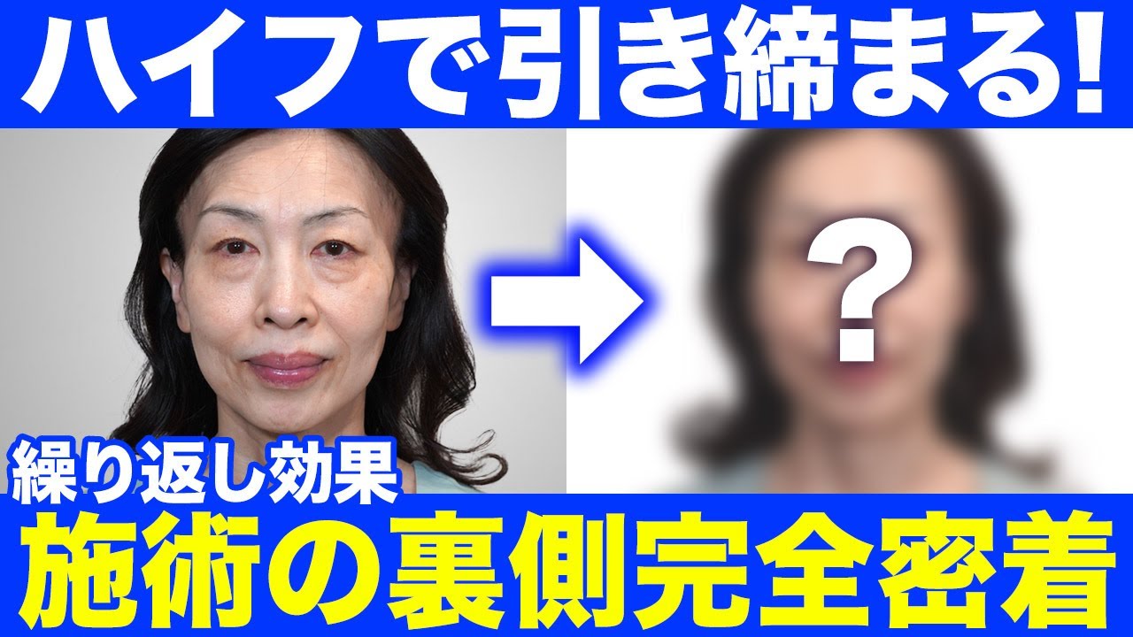 繰り返しやると効果的！HIFU（ハイフ）施術の裏側全部見せます！