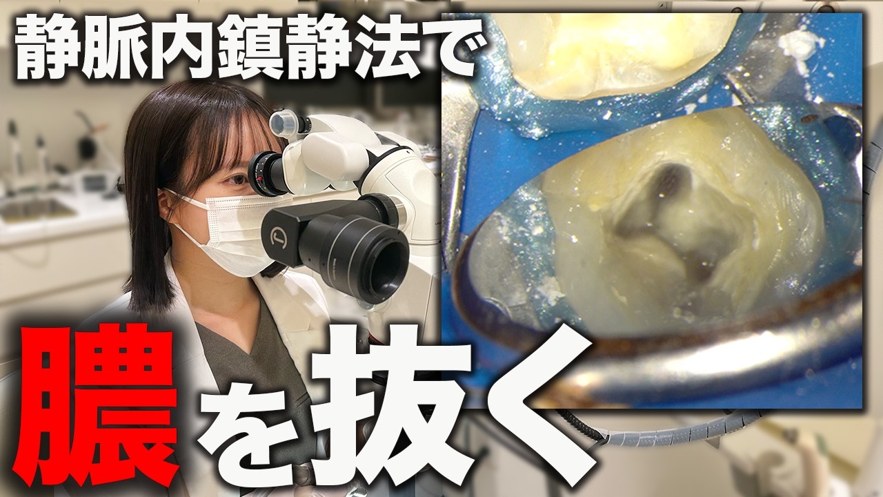 2本の歯の神経治療を一気に静脈内鎮静法で行いました！