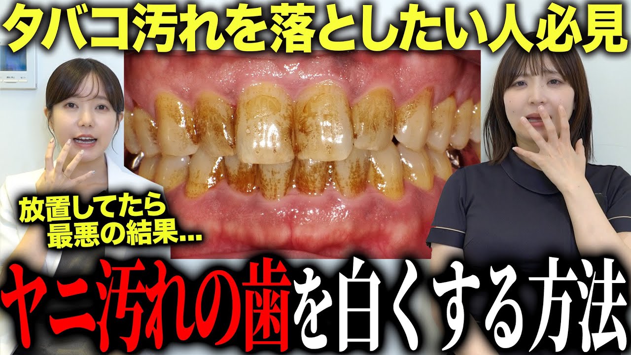【歯のヤニ汚れ】タバコの黄ばみは“削らず”こう落とす！