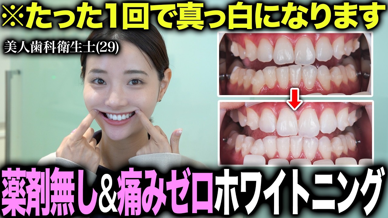 1回で真っ白になる痛くない最新型のトランセントホワイトニングを美人歯科衛生士が1年ぶりにホワイトニング試した結果が...